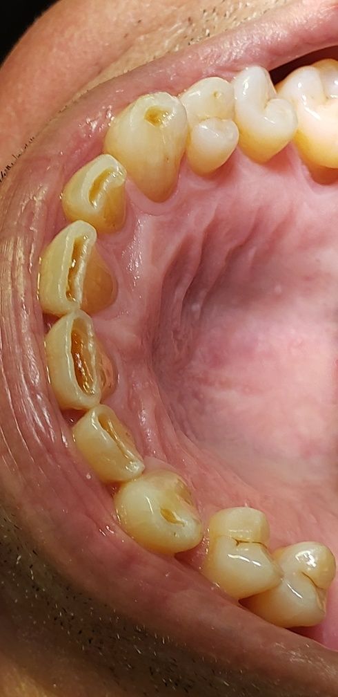 Before Treatment — The Villages, FL — Central Florida Dental