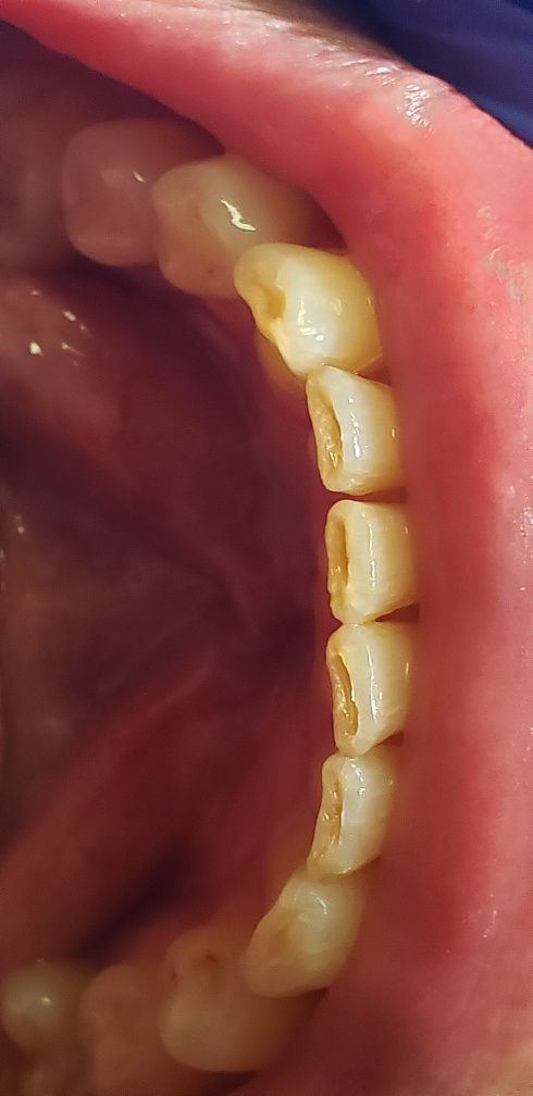 Before Treatment for Lower Teeth — The Villages, FL — Central Florida Dental
