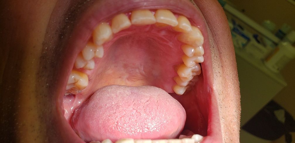 After Treatment — The Villages, FL — Central Florida Dental