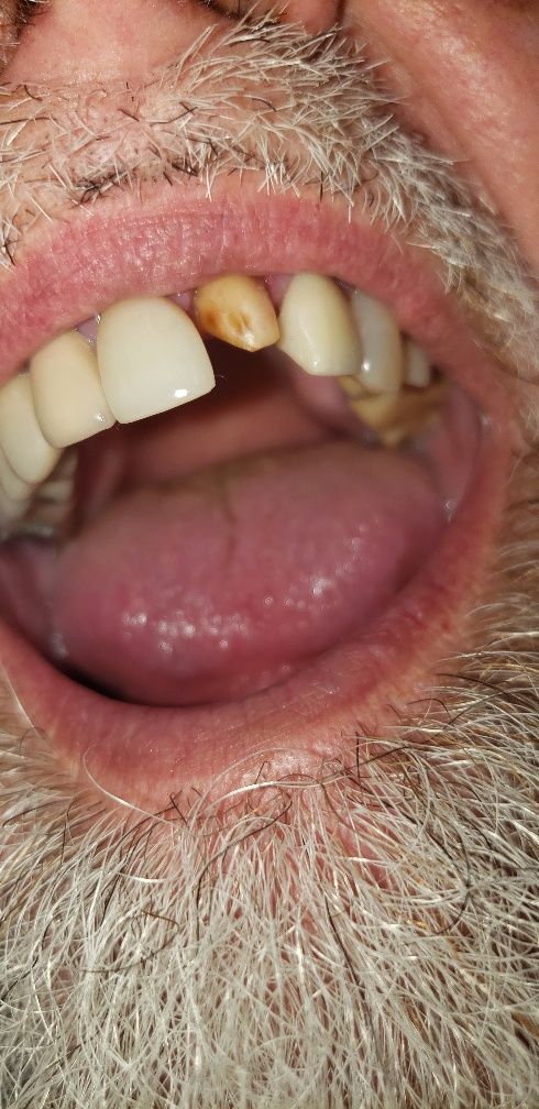 Before Treatment for Lower Teeth — The Villages, FL — Central Florida Dental