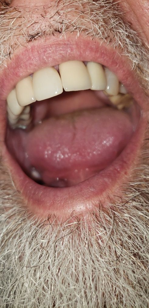 After Treatment for Lower Teeth — The Villages, FL — Central Florida Dental