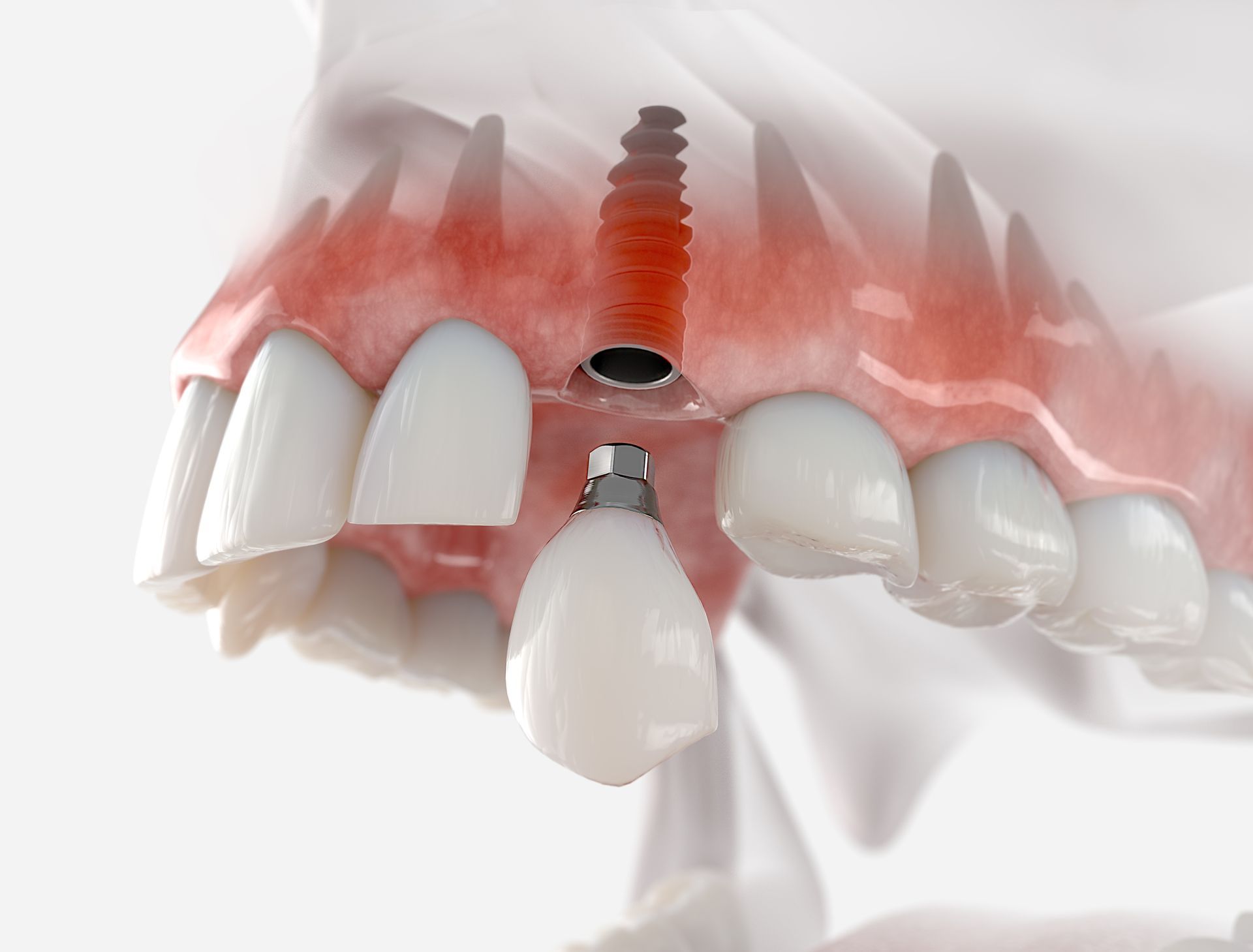 Dental implants supporting a custom crown for a natural-looking tooth replacement
