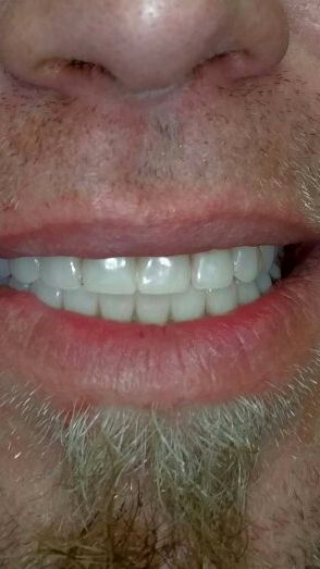 Denture After — The Villages, FL — Central Florida Dental