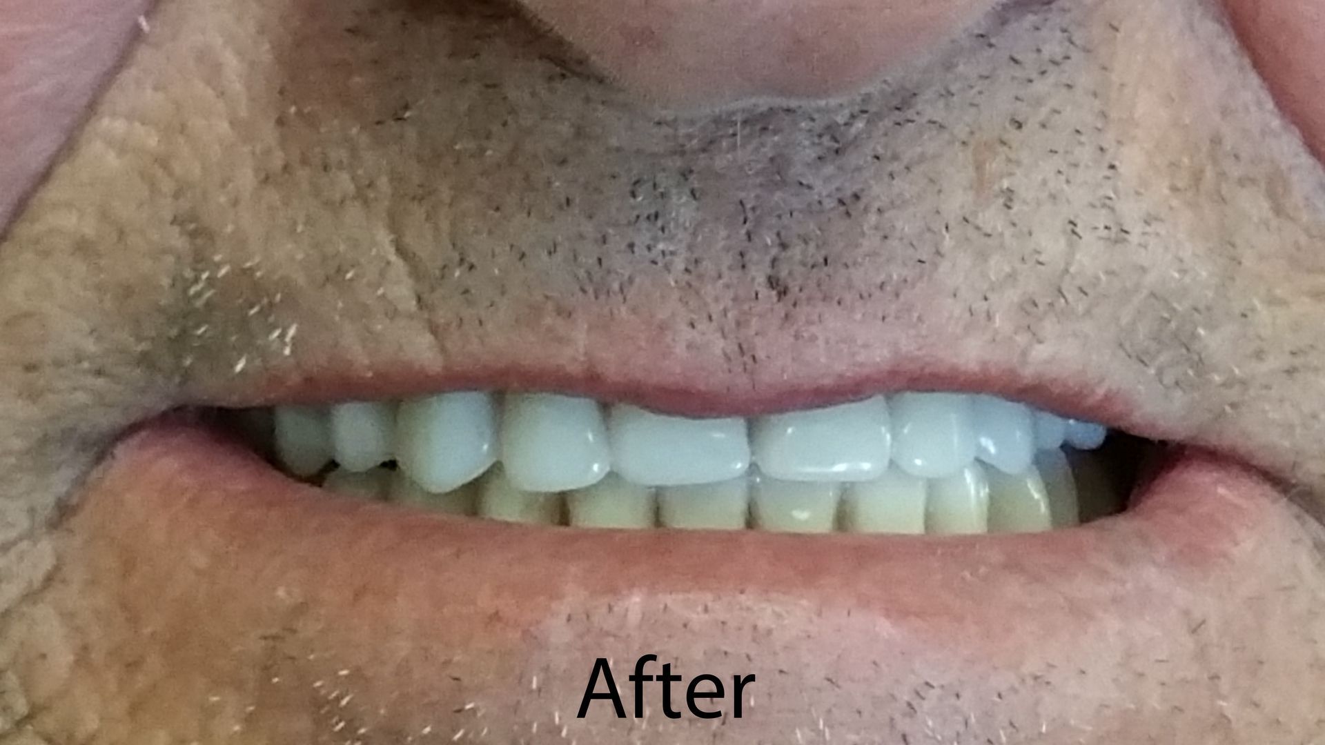 Denture Before — The Villages, FL — Central Florida Dental