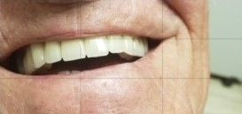 After Fixed Permanent Porcelain Bridge — The Villages, FL — Central Florida Dental