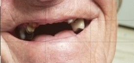 Before Fixed Permanent Porcelain Bridge — The Villages, FL — Central Florida Dental