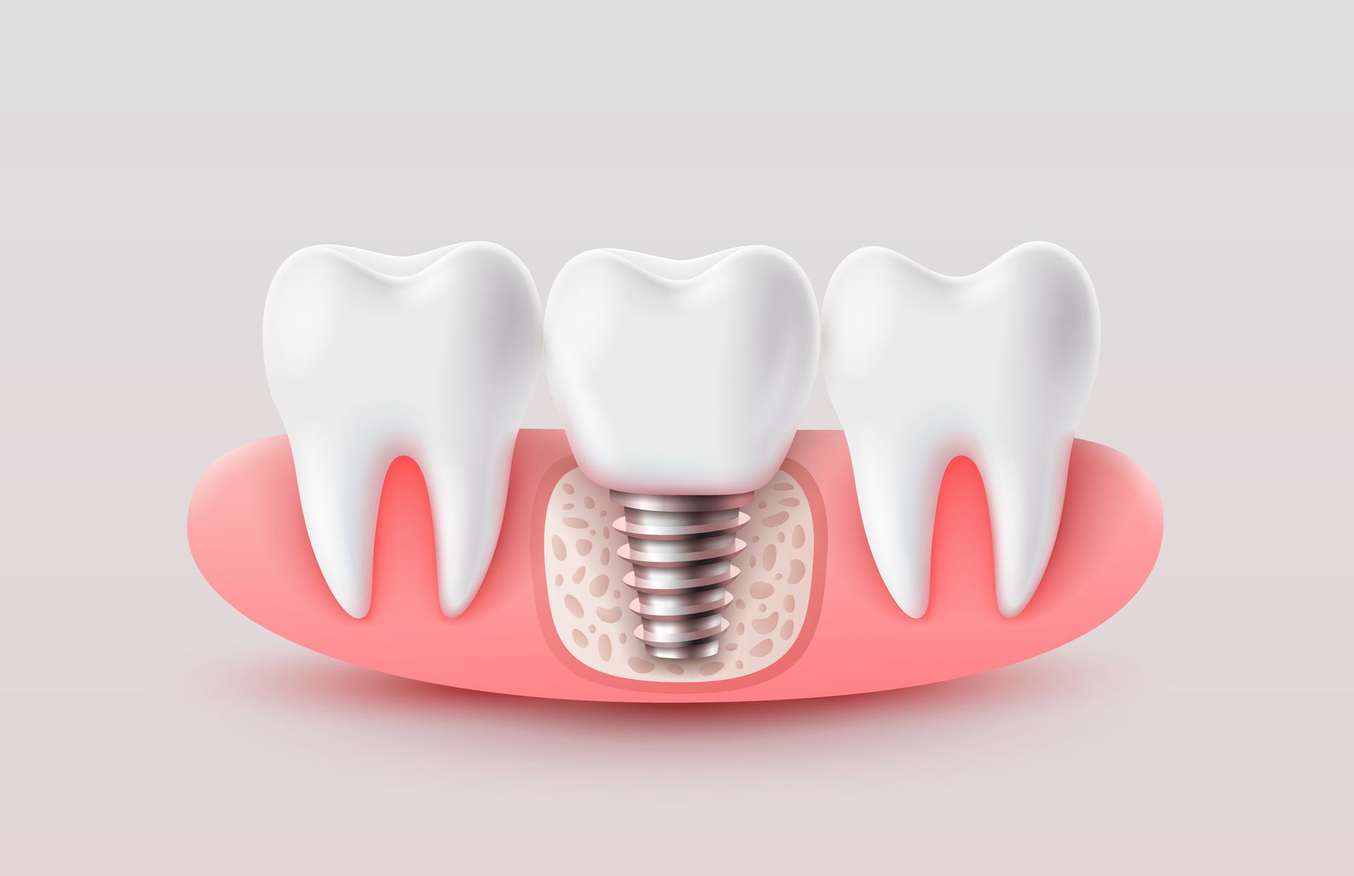 Local dental implants illustration showing titanium post and crown placement.