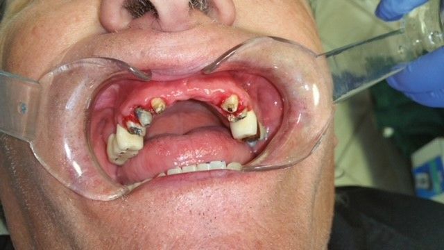 Fixed Permanent Porcelain Bridge Before — The Villages, FL — Central Florida Dental