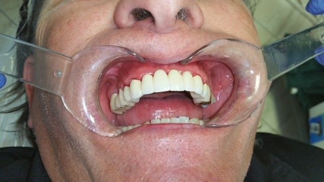 Fixed Permanent Porcelain Bridge After — The Villages, FL — Central Florida Dental
