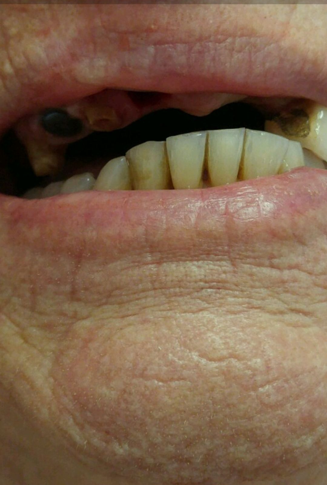 Damaged Teeth  — The Villages, FL — Central Florida Dental