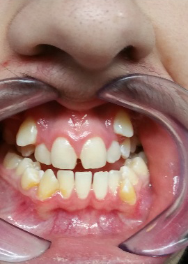 Crooked Teeth Before Braces — The Villages, FL — Central Florida Dental