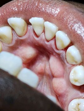 After Periodontal Cleaning — The Villages, FL — Central Florida Dental