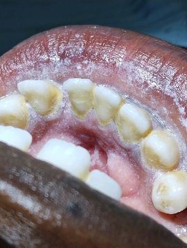 Before Periodontal Cleaning — The Villages, FL — Central Florida Dental