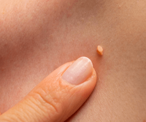 Blemish Treatment