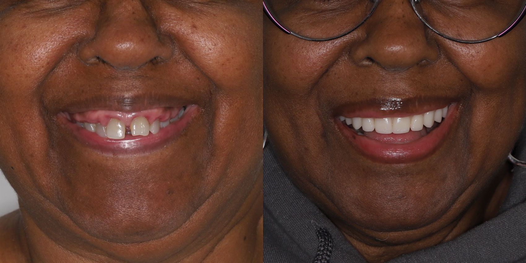 Before and After Betty