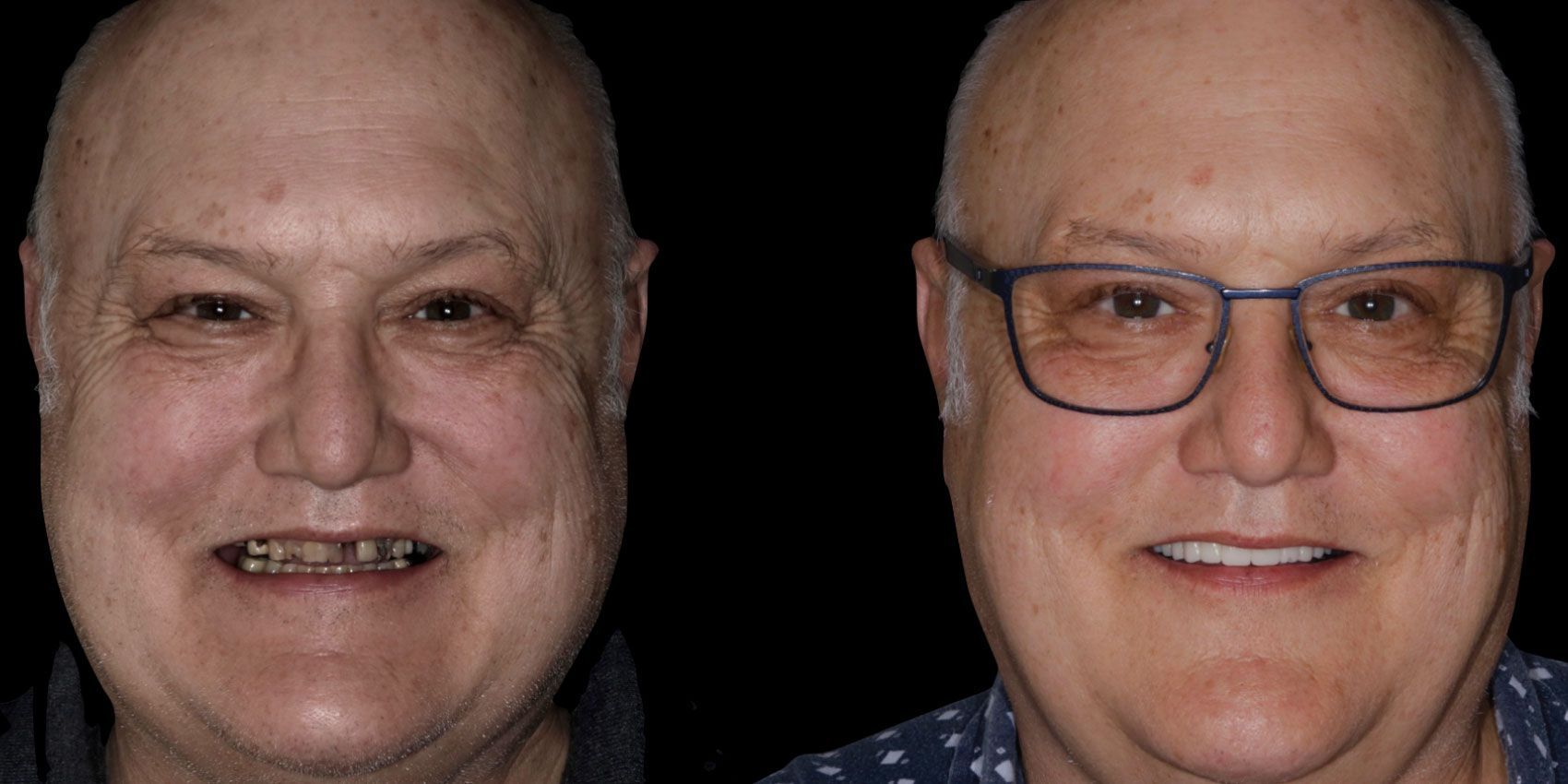 Before and After Frank