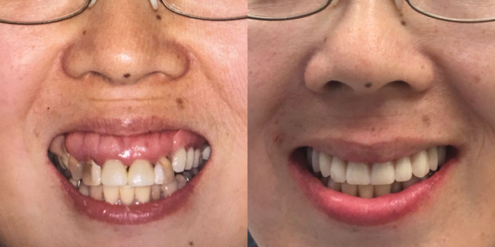 Before and After Tina