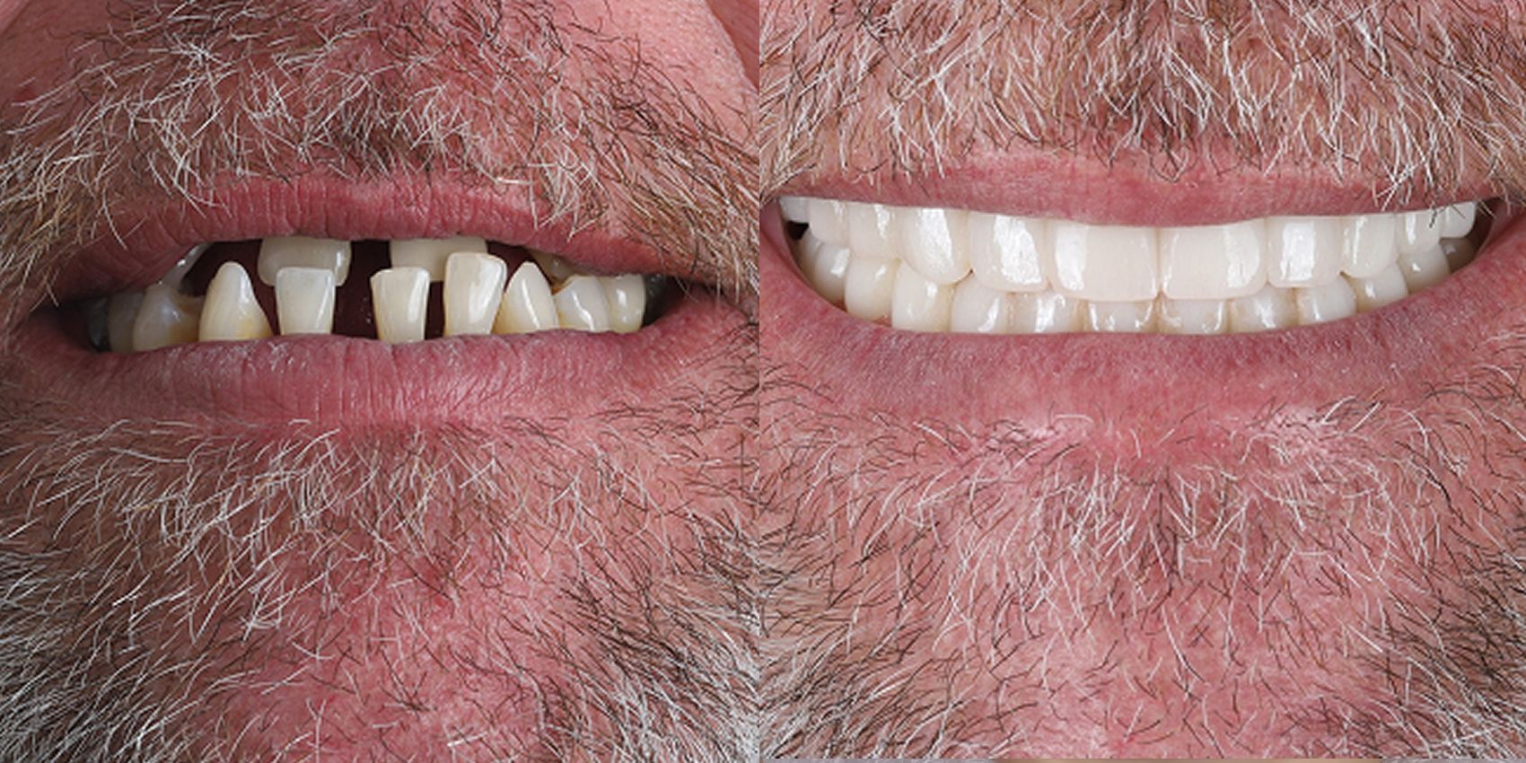 Before and After Molden