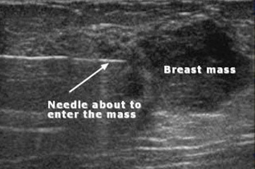 Ultrasound image showing a needle about to enter a breast mass, with labels and arrow.