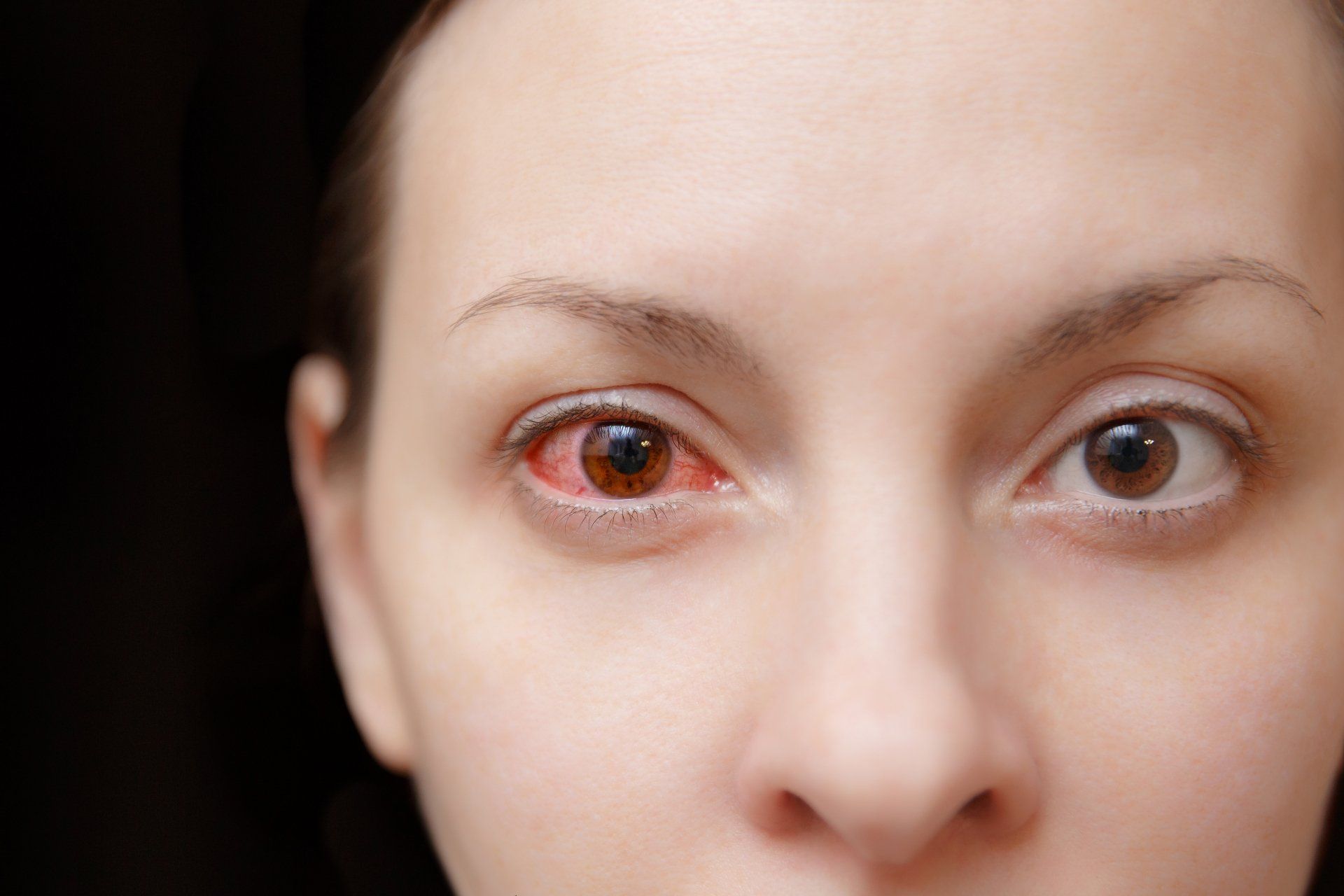 Allergic Conjunctivitis & Allergy Testing in Brisbane & Gold Coast | Allergy First