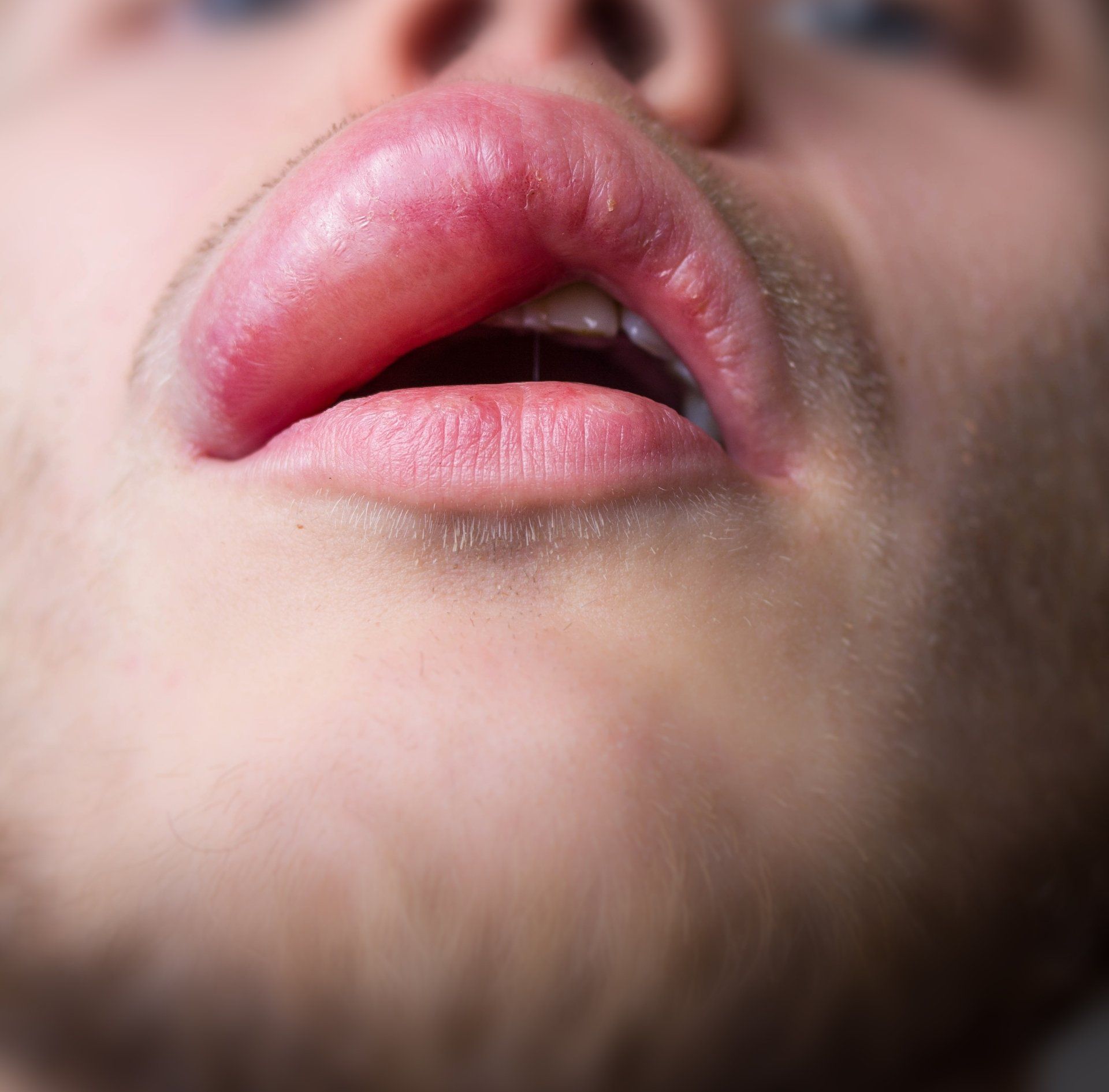 Angioedema - Allergy Testing Brisbane | Allergy Testing Gold Coast | Allergy Testing Sunshine Coast