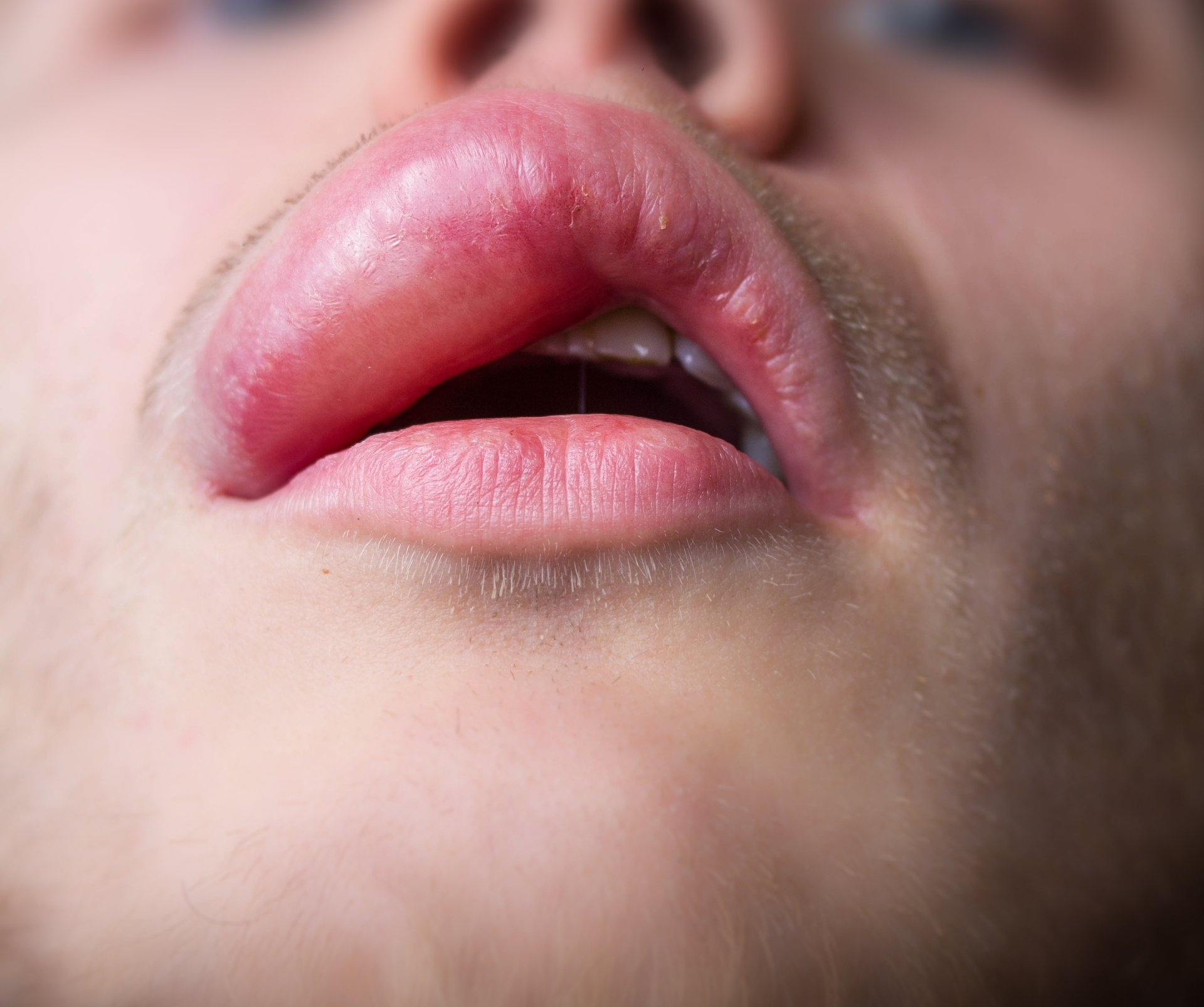 Food Allergy Symptoms | Allergy First Allergy Clinics