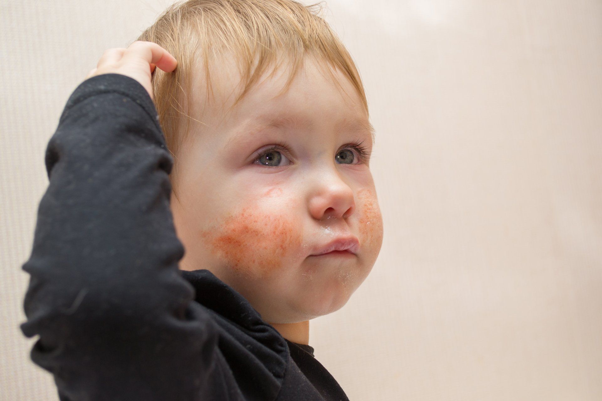 Eczema (Atopic Dermatitis) - Allergy Testing Brisbane | Allergy Testing Gold Coast | Sunshine Coast