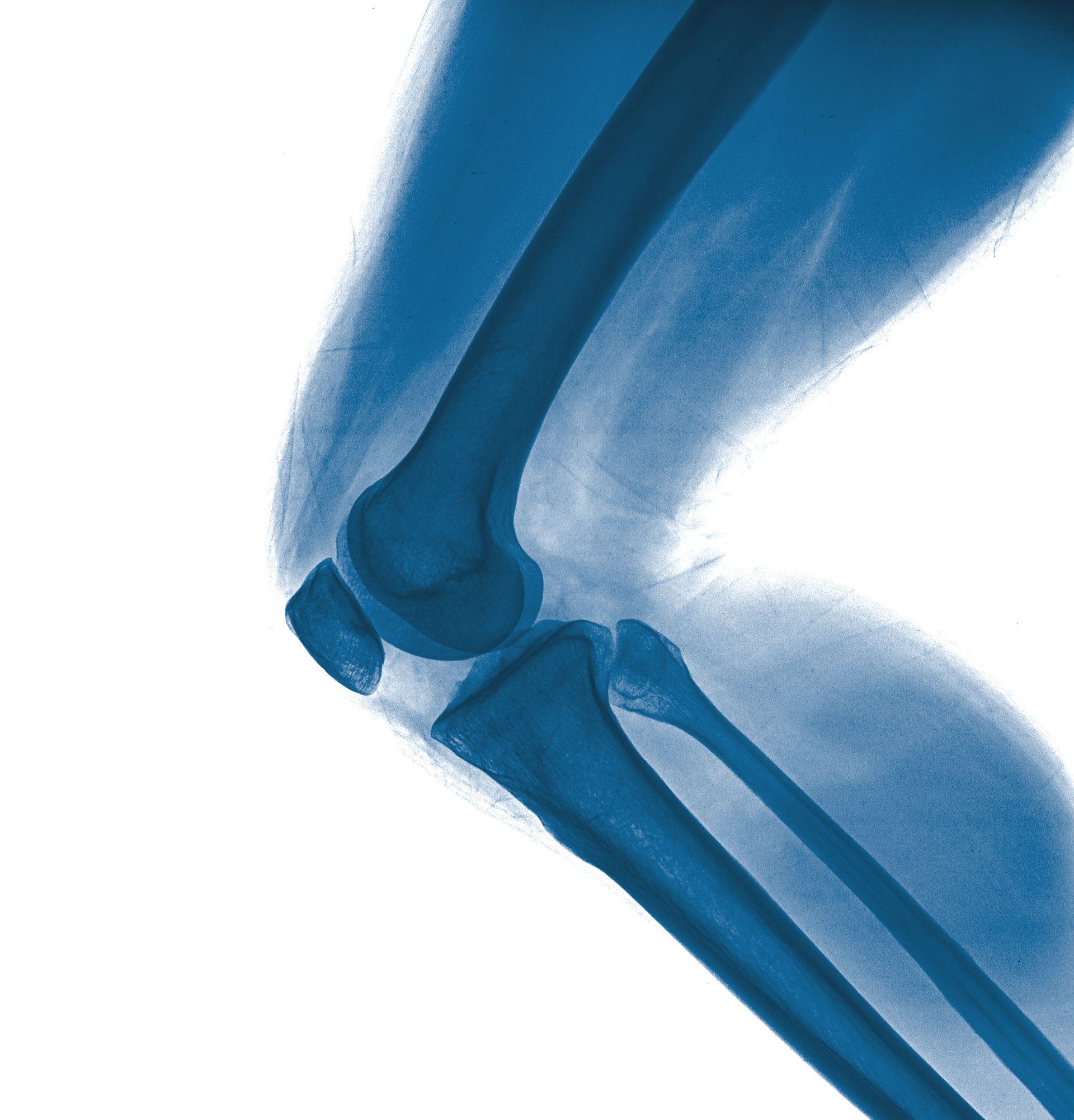 Metal Allergy and Orthopedic Surgery | Allergy Clinic Brisbane | Allergy Clinic Gold Coast