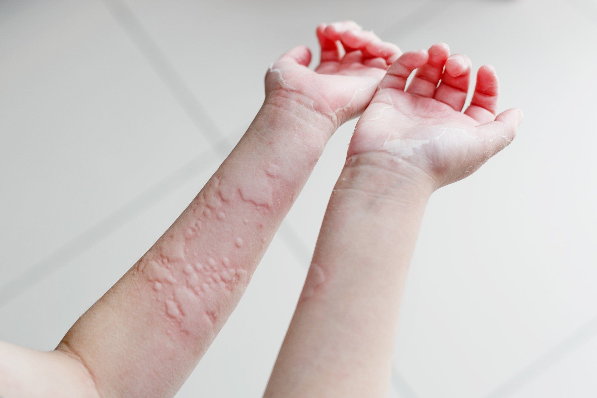 Urticaria (Hives) - Allergy Clinic Brisbane | Allergy Clinic Gold Coast | Allergy Sunshine Coast