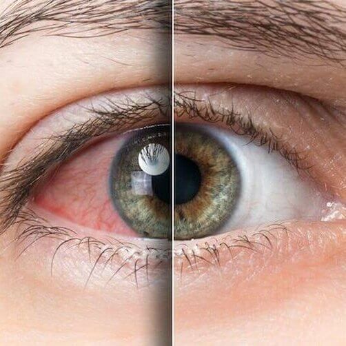 dry eye
