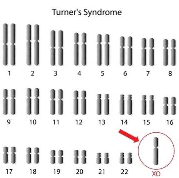 turner's sindrom