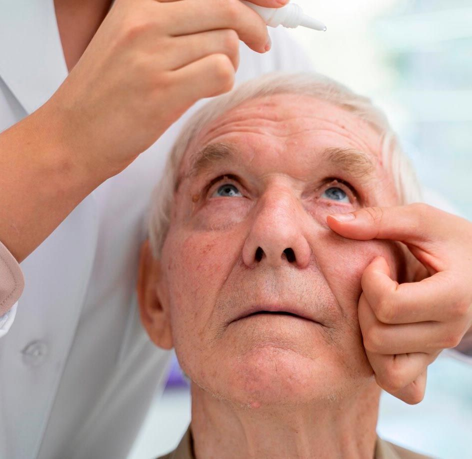 A woman is applying eye drops to an older man 's eye for dry eye treatment