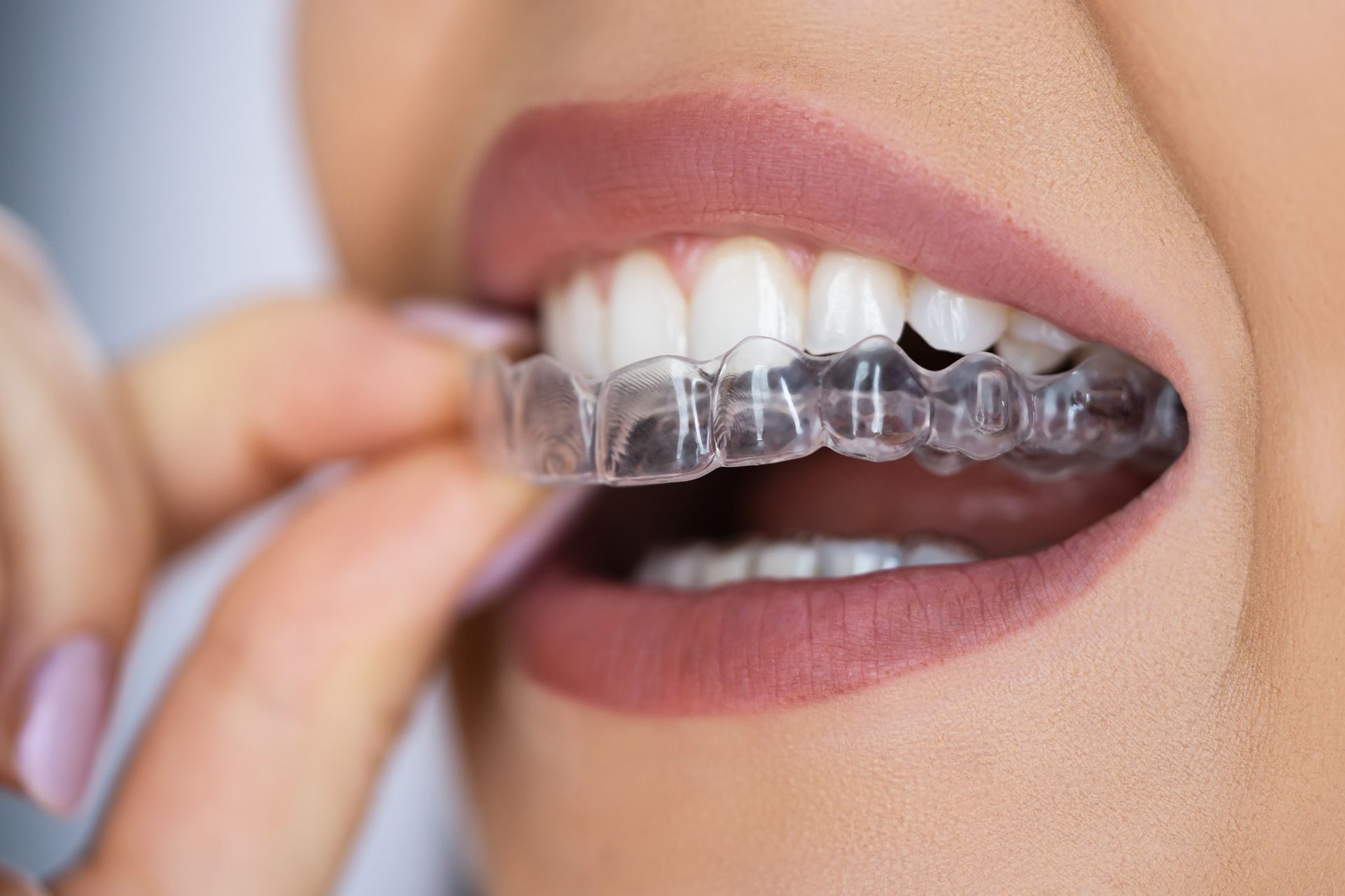 Dental services hornsby nsw smile health dental care