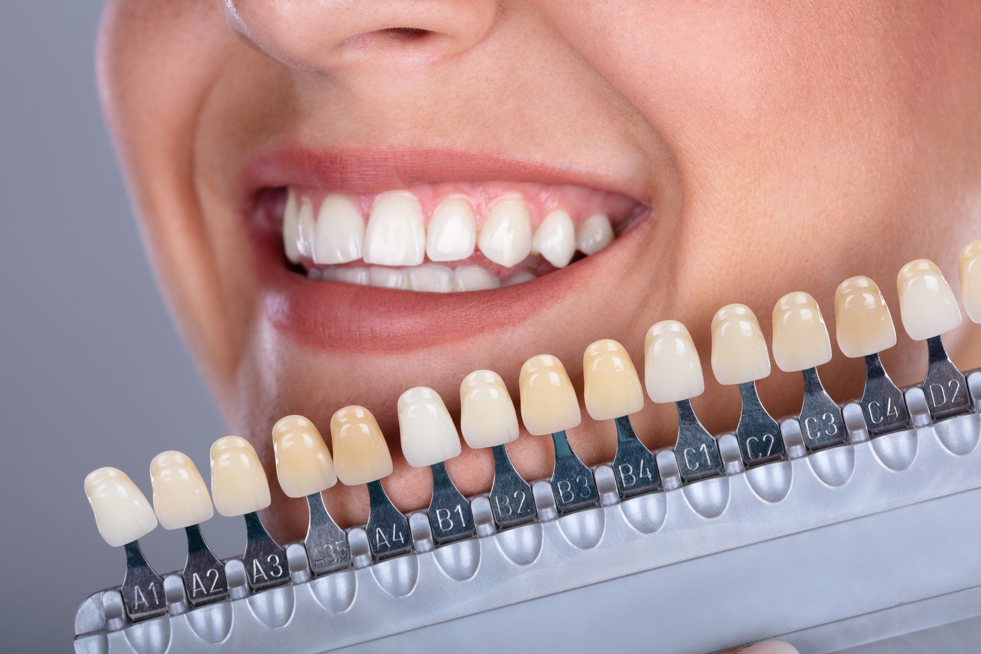 Veneers — Hornsby, NSW — Smile Health Dental Care