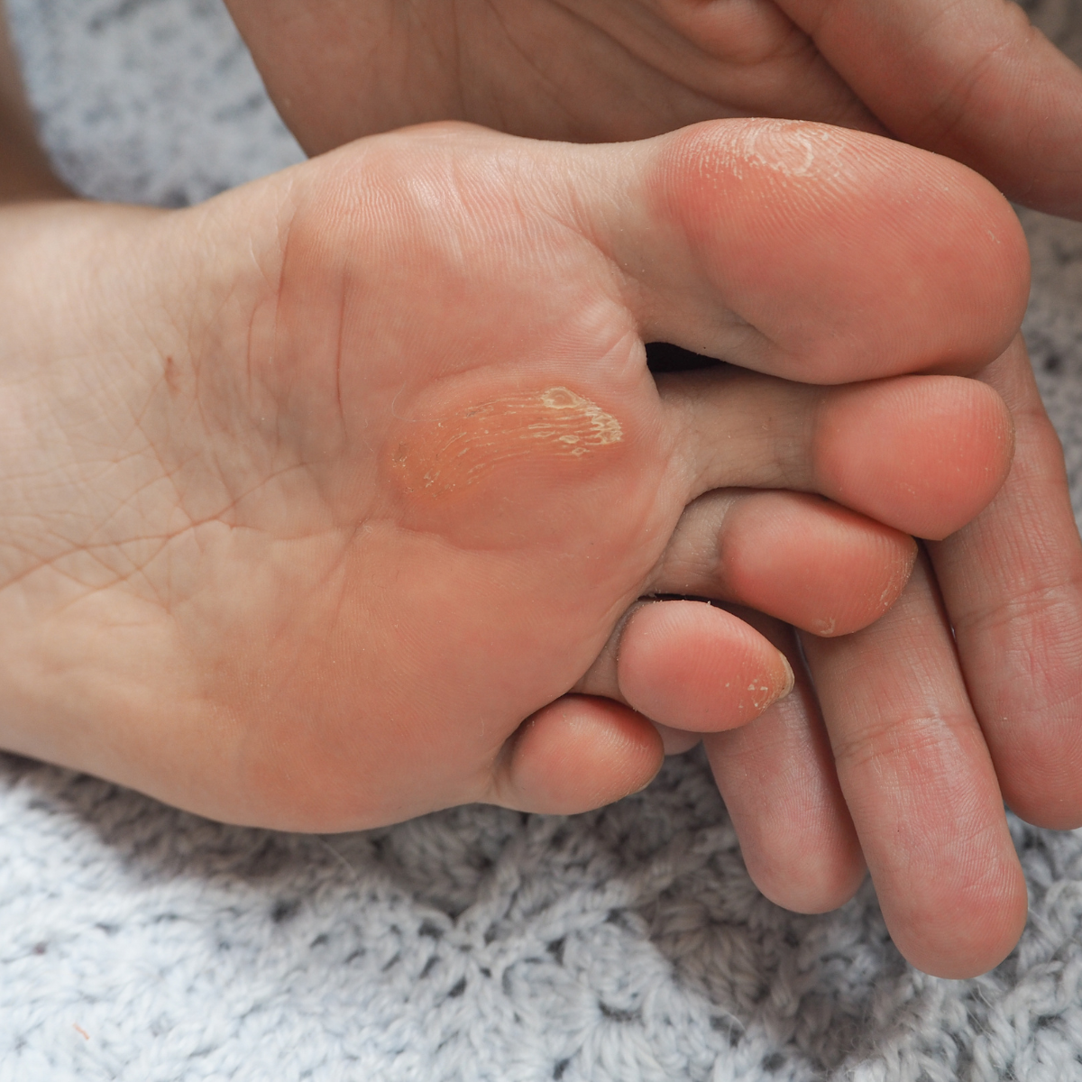 Corns & Calluses