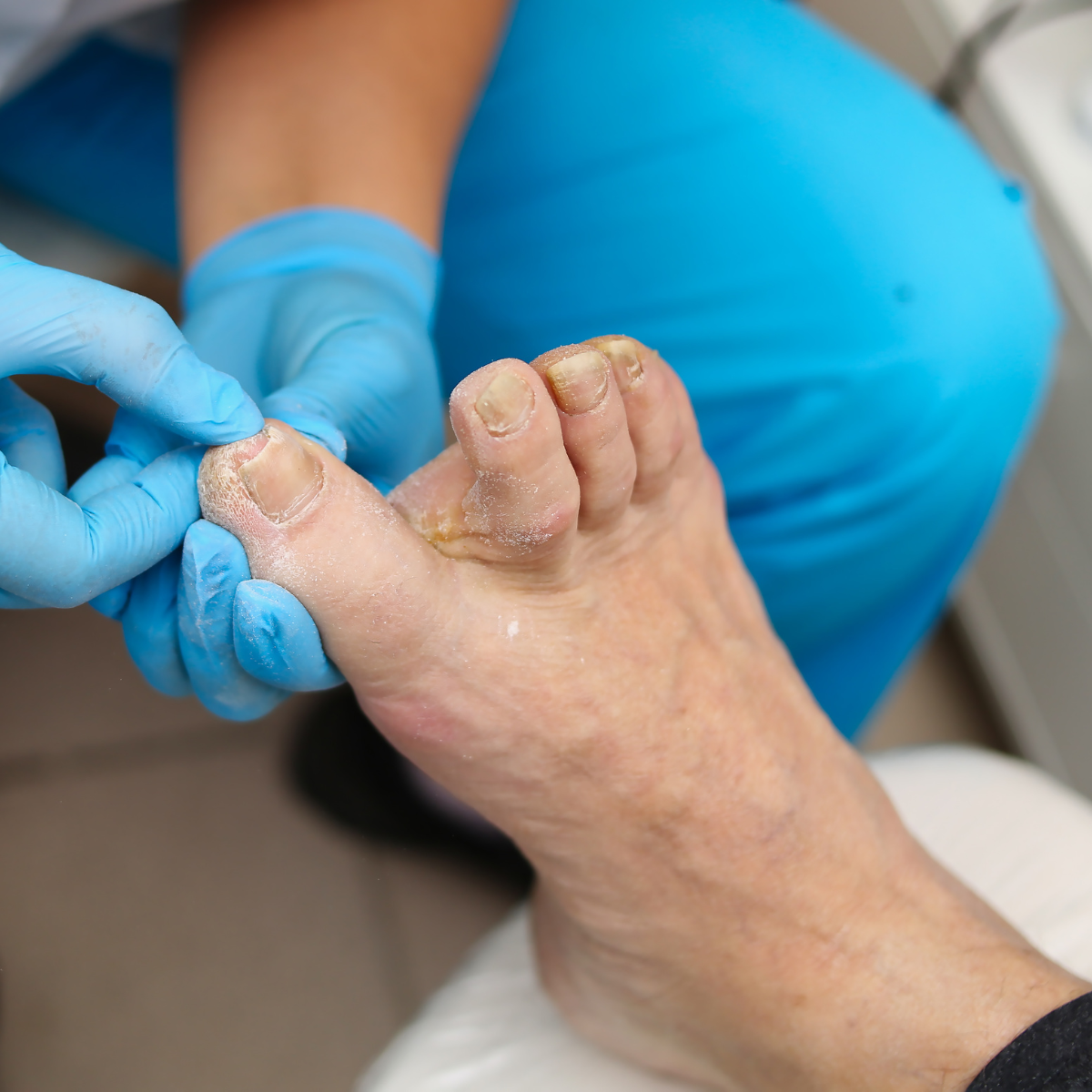 Ingrown Toenails