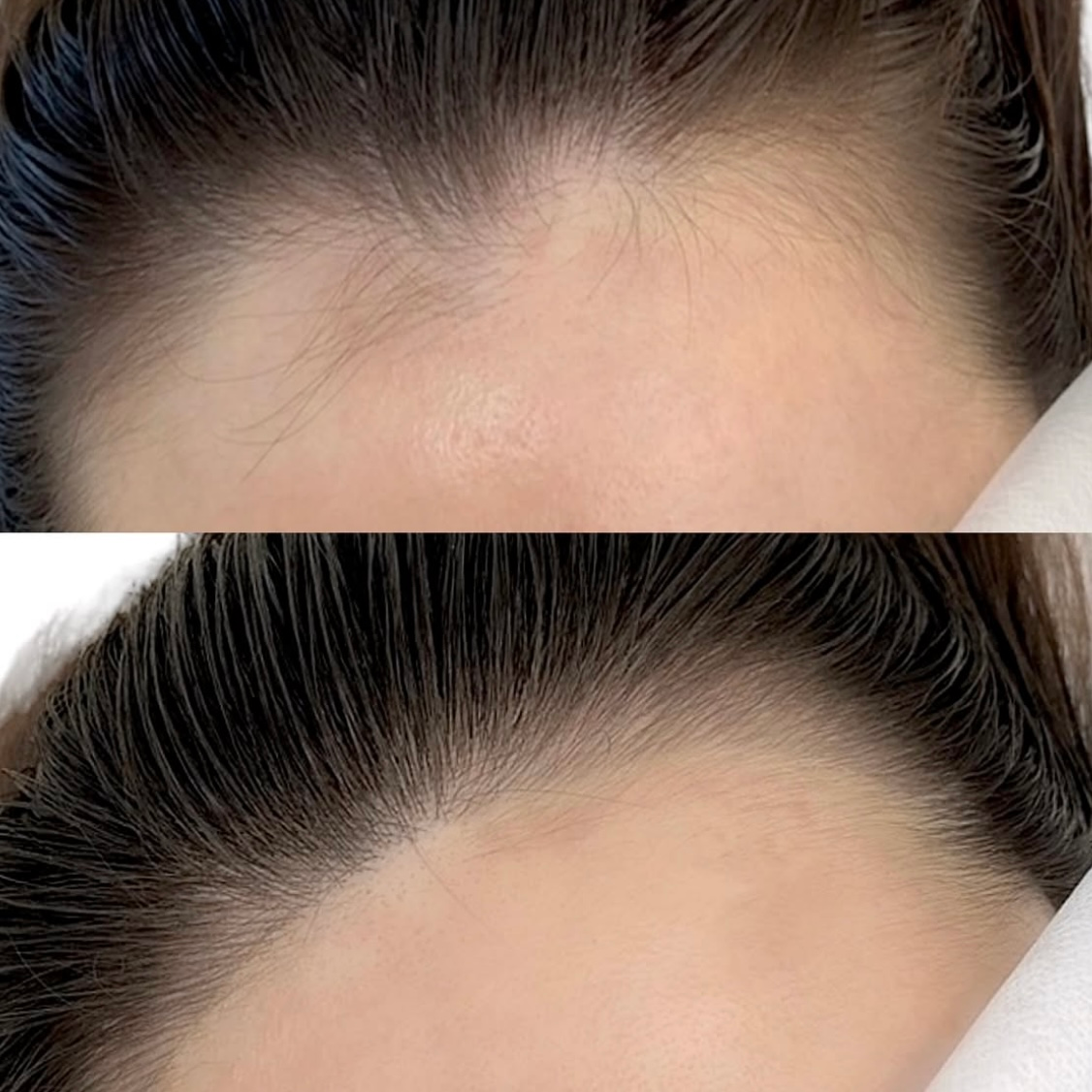 Comparison of a hairline: top view shows sparse hair; bottom view shows thicker hair.