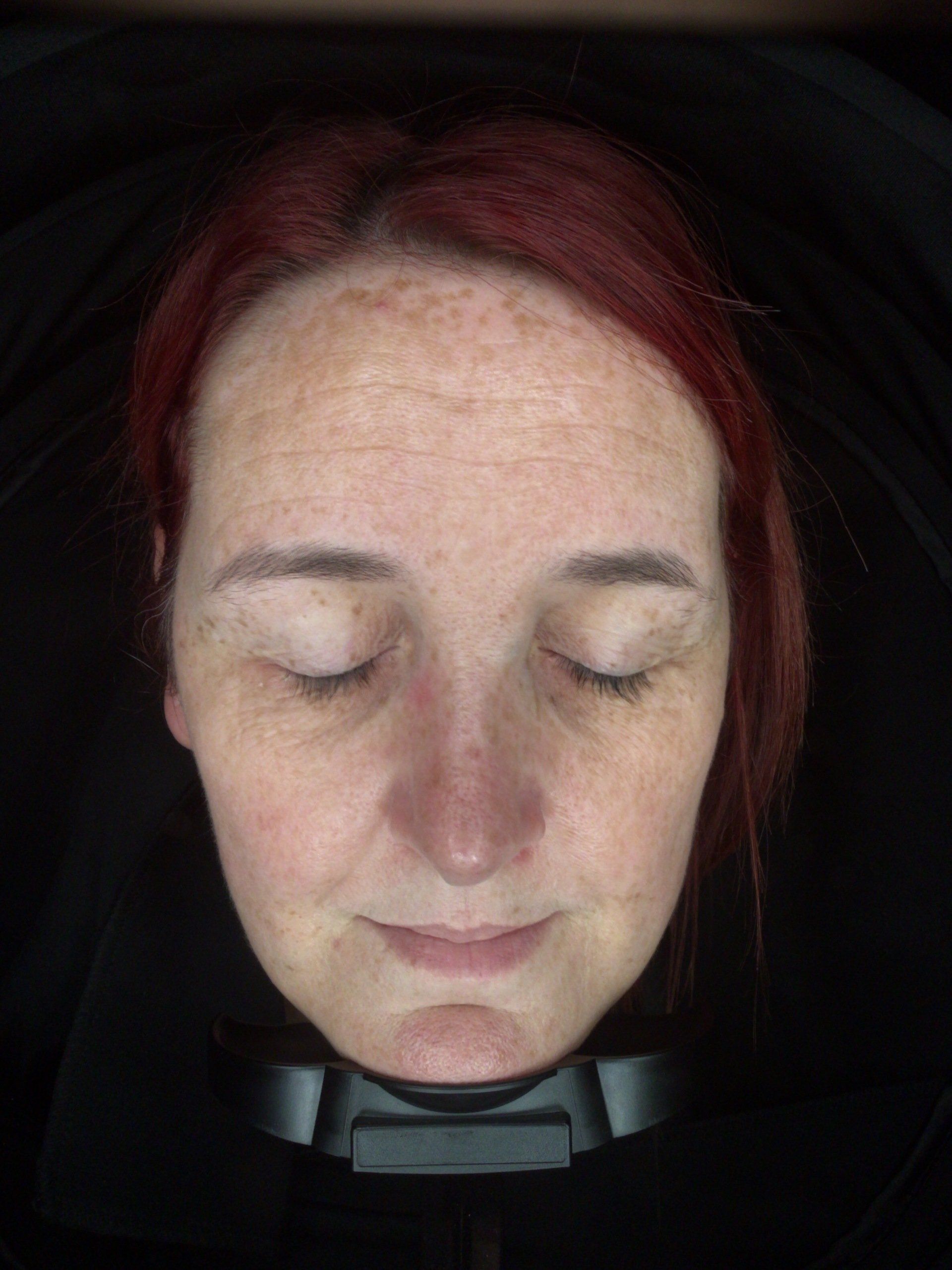 Skin analysis before