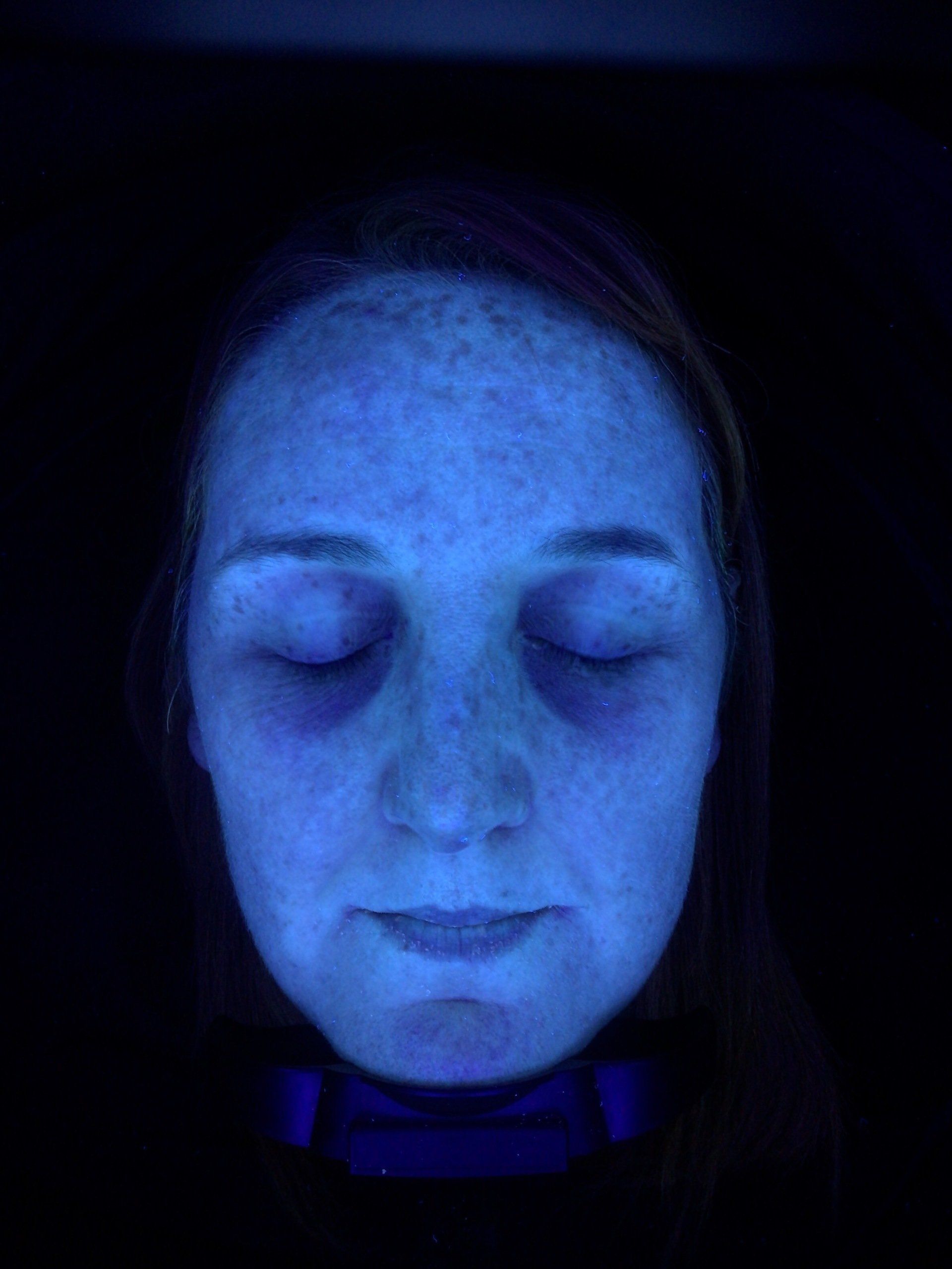 Skin analysis after