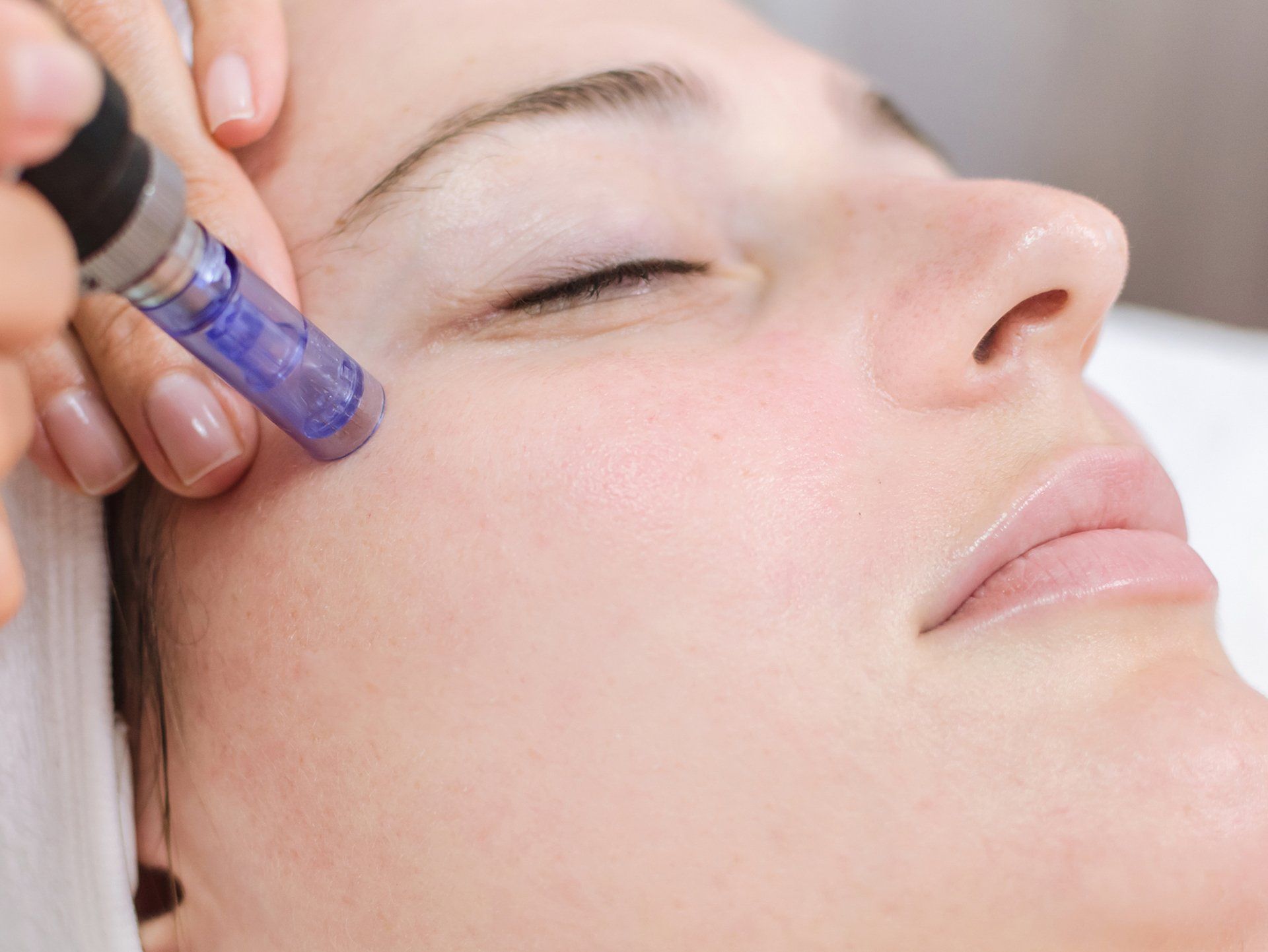 Microneedling Crosby Liverpool