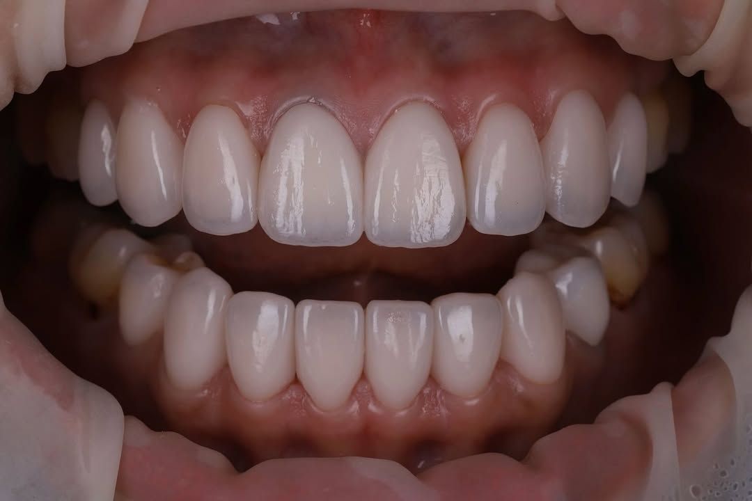 帶著自然笑容回家過年|Ms. Chen|黃琮勛醫師 美容牙科|頂級陶瓷貼片|微笑設計