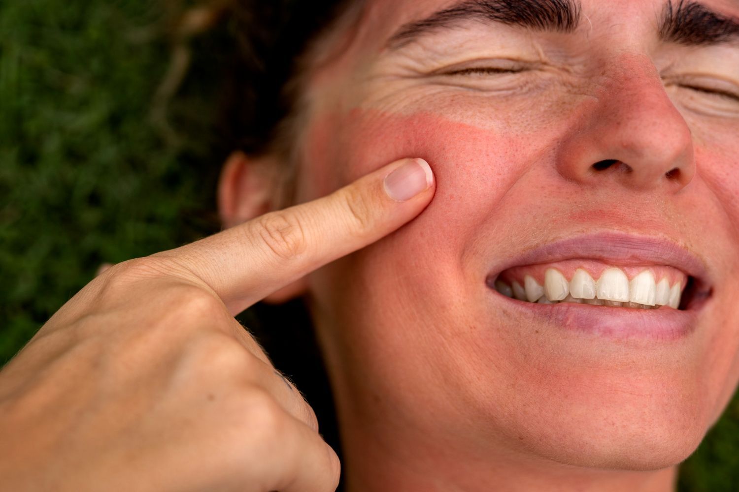 A close-up of a person touching a patch of reddened, sunburnt skin on their cheek.