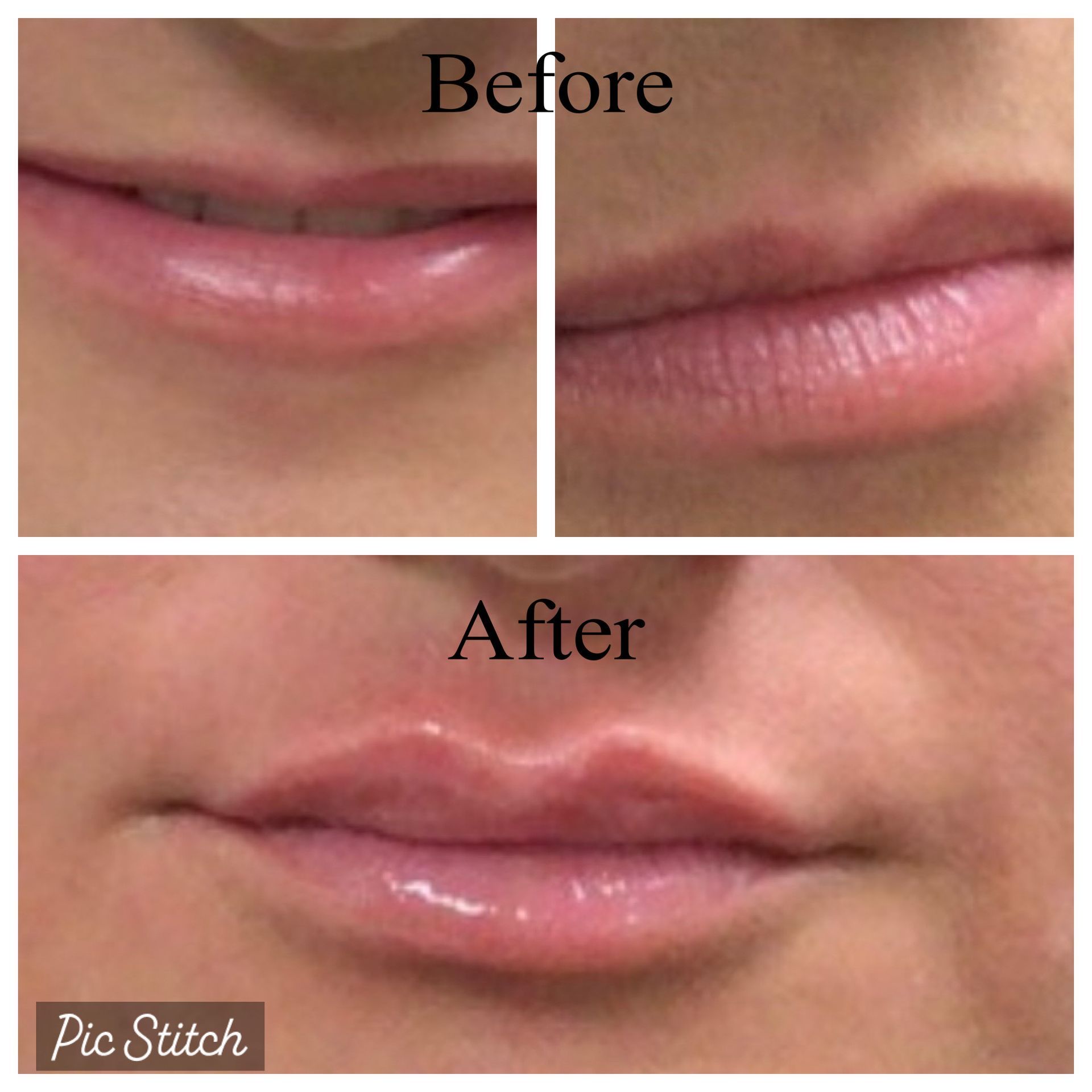 Comparison of lips before and after lip filler treatment, showing fuller lips in the