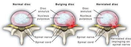 illustration of discs