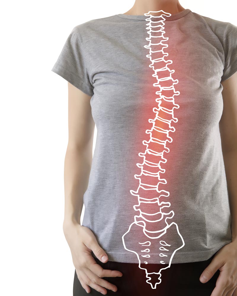 illustration of scoliosis on a woman