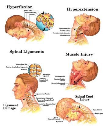 Injury treated through whiplash treatment in Jacksonville, FL