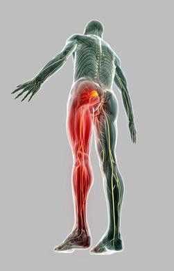 illustration of sciatic pain