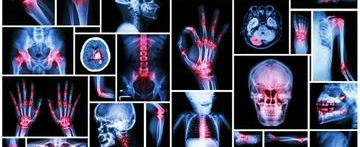 xrays of joints