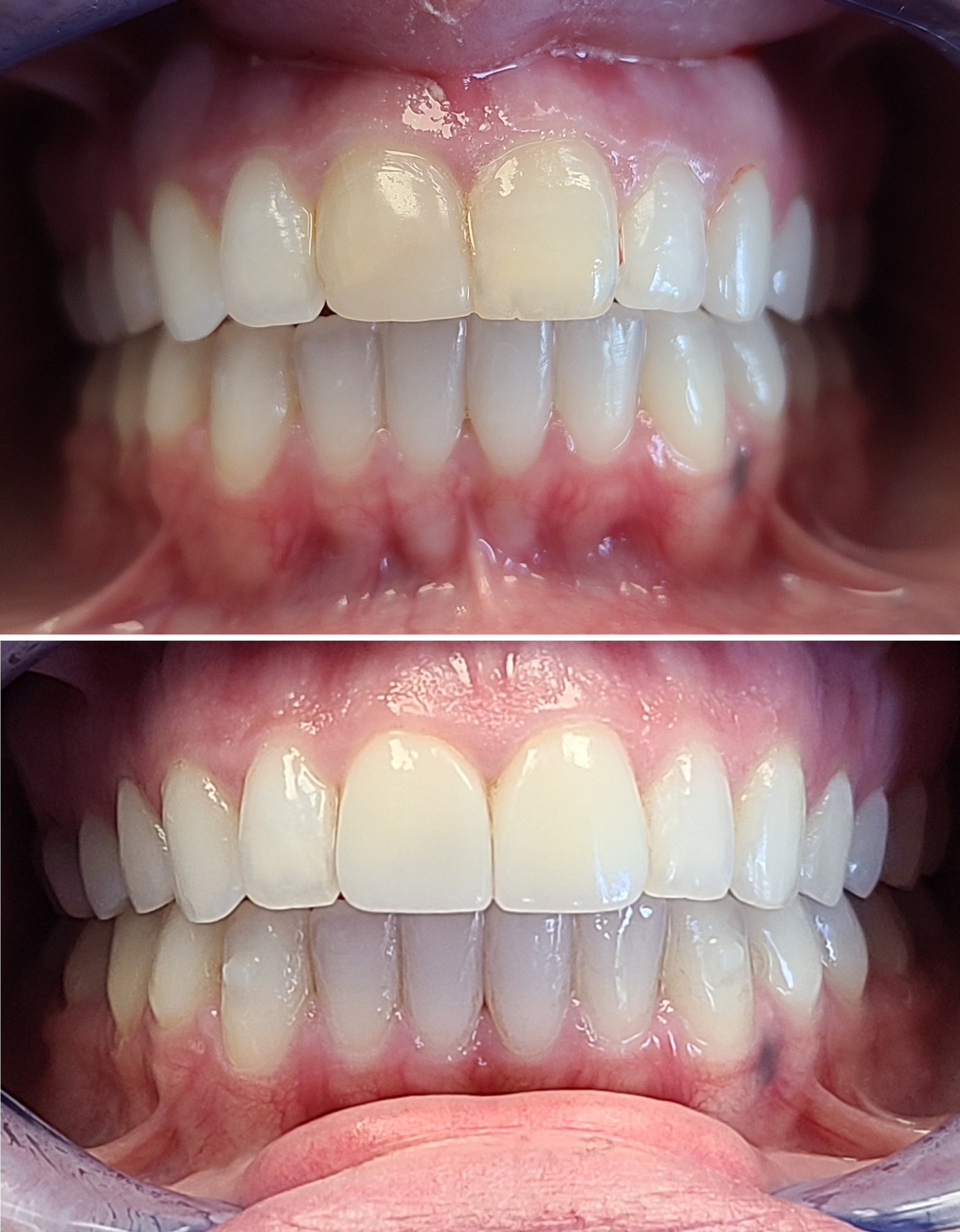 Dental Veneers on Long Island