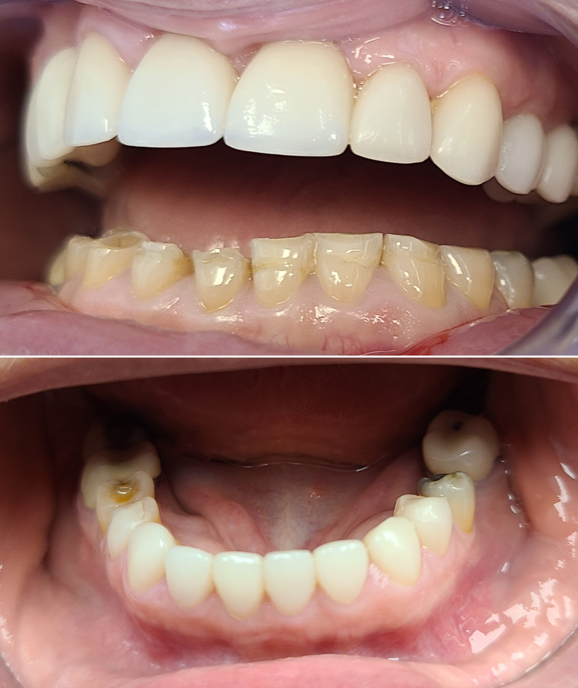 Dental Procedure done by Dr. Coleen L. Catera DMD at her practice on Long Island